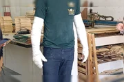 Ele ficou com queimaduras nos braços Ele ficou com queimaduras nos braços
