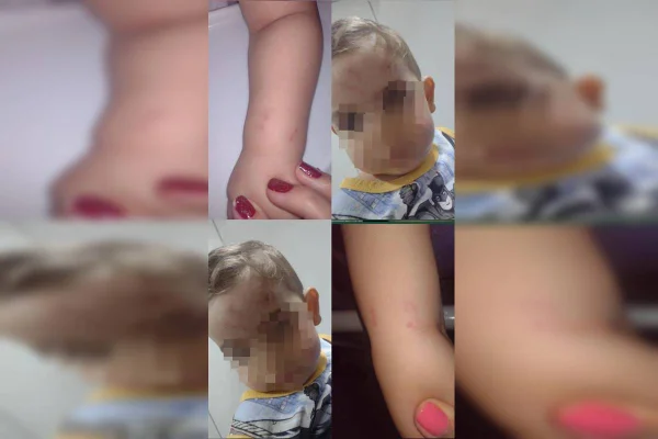 Mãe denuncia creche após filho chegar em casa com machucados. Veja
