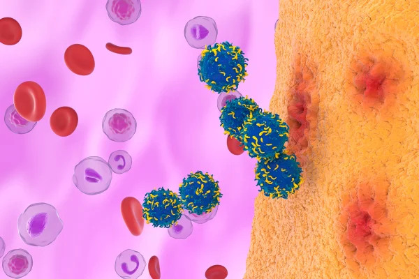 Ilustração mostrando células T com receptor de antígeno quimérico (CAR) (em azul) sendo usadas para tratar artrite reumatoide, uma doença autoimune que afeta principalmente as articulações. Metrópoles