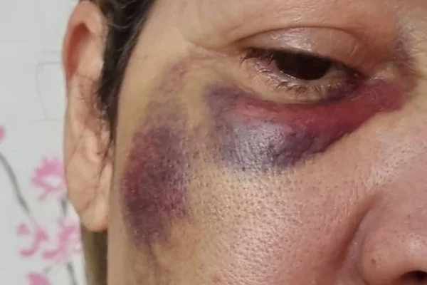 Mulher agredida - Metrópoles