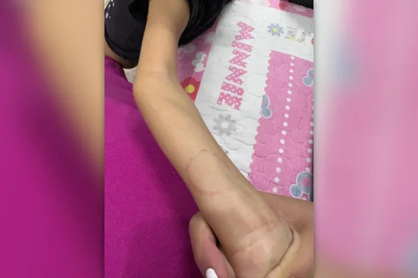 Mãe denuncia agressão e maus-tratos contra filha autista em creche - destaque galeria