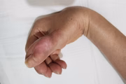 Mulher-tem-infeccao-no-dedo-apos-ir-na-manicure-2 Mulher tem infecção após fazer as unhas e passa por 4 cirurgias