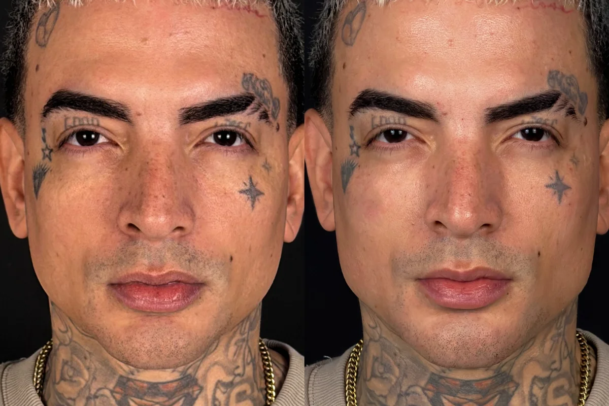 O cantor MC Guimê revelou que voltou ao consultório para atualizar a harmonização facial O cantor MC Guimê revelou que voltou ao consultório para atualizar a harmonização facial