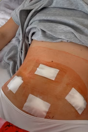 A modelo fez uma cirurgia para tratar a condição 