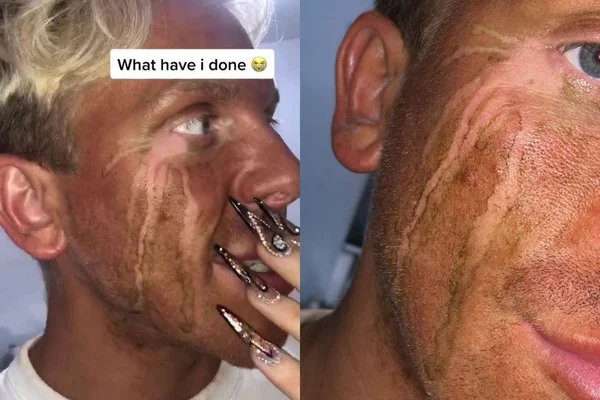 Jovem fica com o rosto todo manchado após chorar com autobronzeador