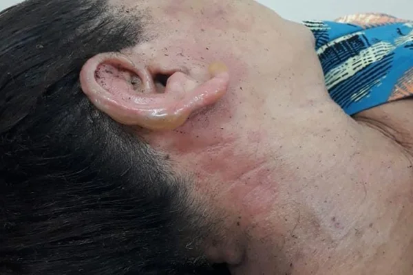 orelha com bolha de queimadura