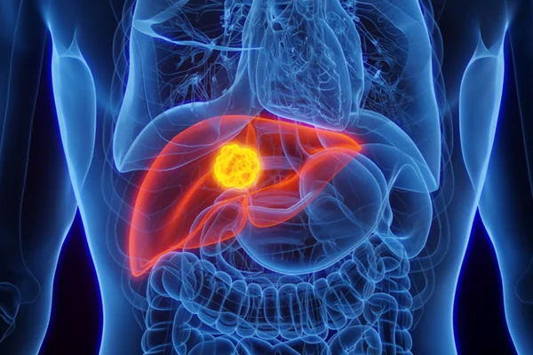 Ilustração de tumor no fígado - Estudo sugere que reduzir proteína pode desacelerar câncer de fígado - Metrópoles