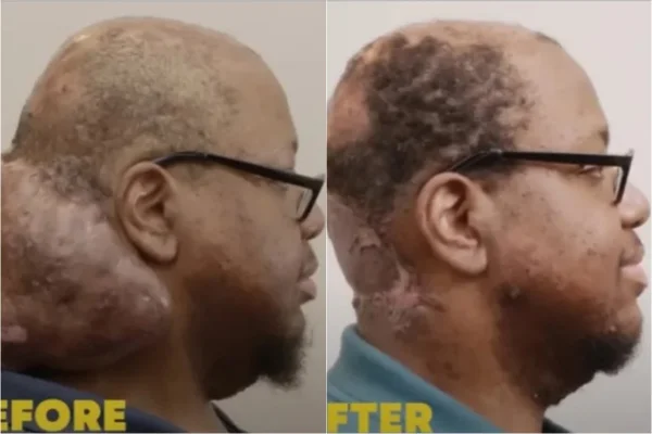 Duas fotos de homem de perfil: na primeira com tumor no pescoço - Metrópoles