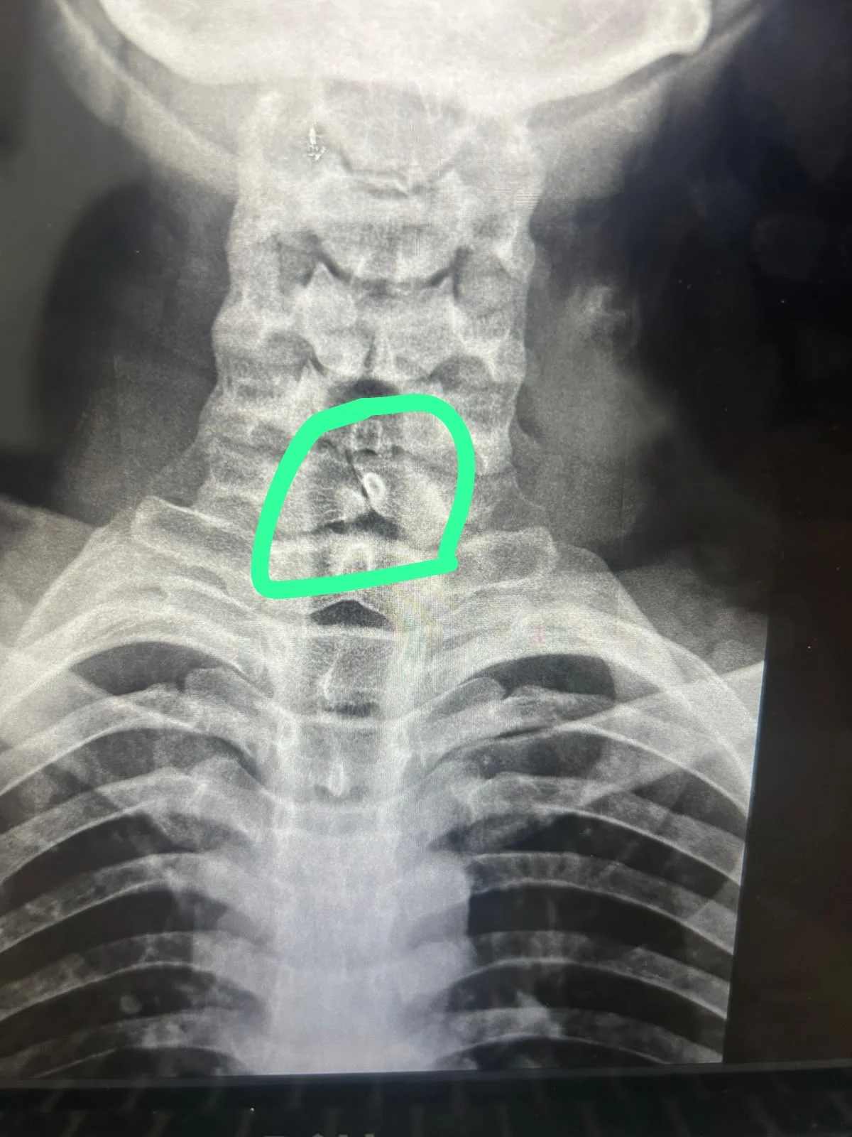 Raio X mostrando a fratura na cervical de Yago Raio X mostrando a fratura na cervical de Yago