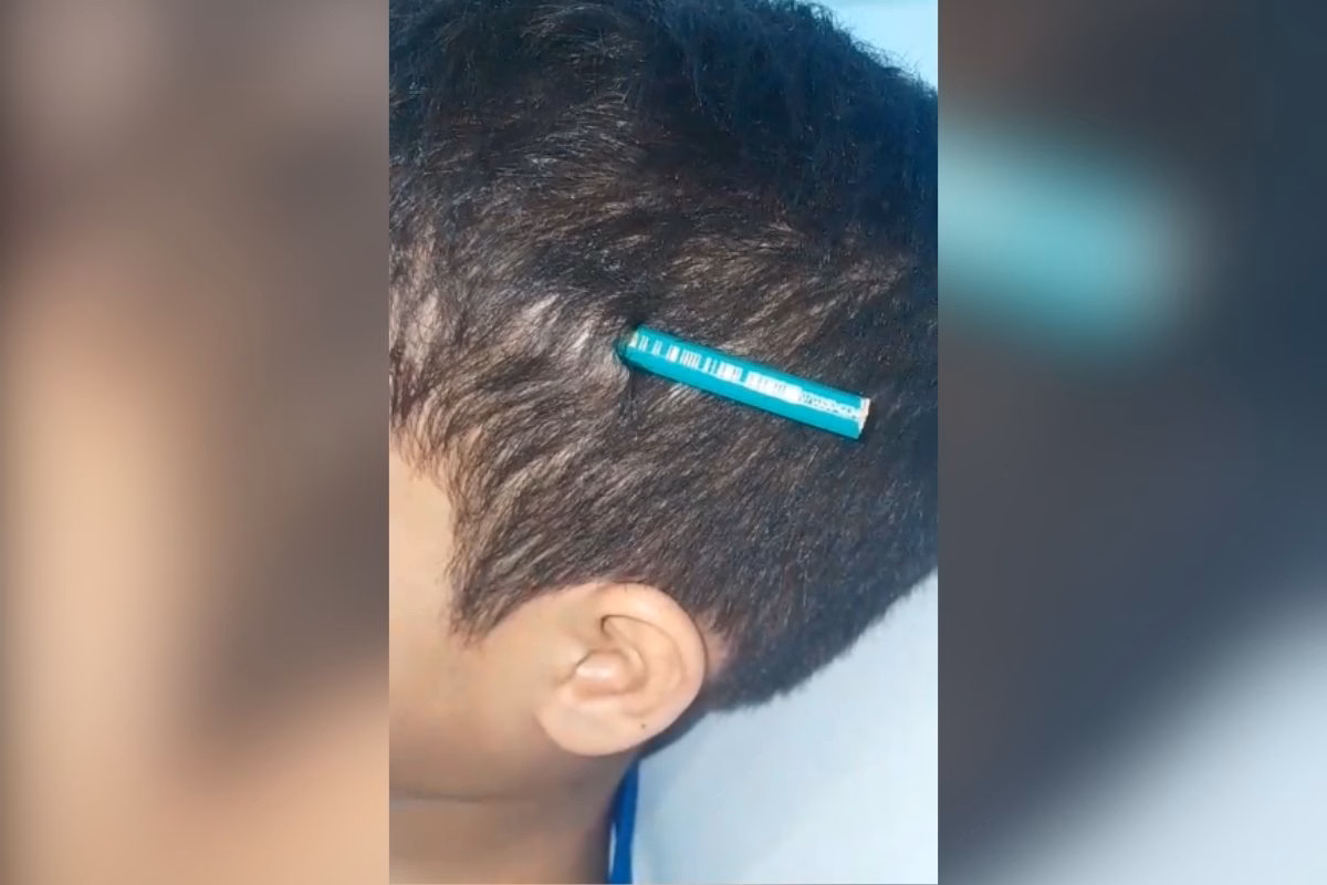 Imagem colorida mostra o lápis fincado na cabeça de estudante. Metrópoles