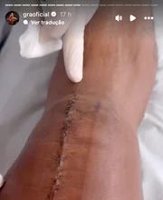 Gracyanne Barbosa mostrou a cicatriz que ficou