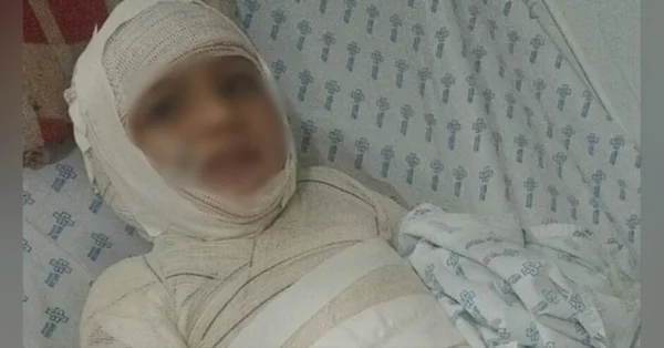 Foto colorida e borra de de Isaque, de 7 anos, que queimou 47% do corpo