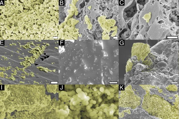 Foto microscópica e eletrônica de varredura de fragmentos de cálculos renais - Estudo encontra bactérias em cálculos renais mais comuns - Metrópoles