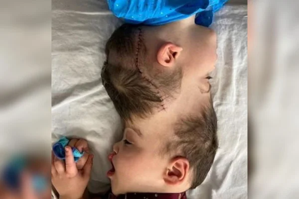 Veja fotos de antes e depois da separação de siameses brasileiros