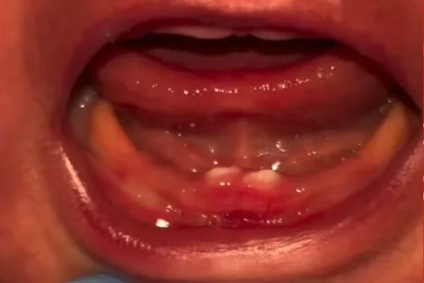 Imagem colorida mostra bebê que nasceu com dentes - Metrópoles