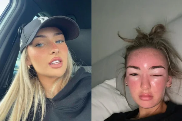 Llio Williams compartilhou em seu perfil no TikTok o inchaço em seu rosto após sofrer insolação durante uma viagem de férias
