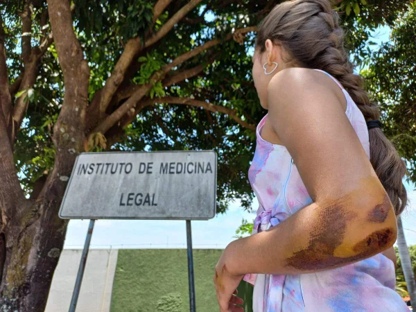 Adolescente com cotovelo machucado veste vestido colorido e olha para placa do IML
