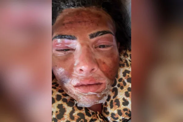 Imagem colorida de uma mulher com o rosto descascando após procedimento estético