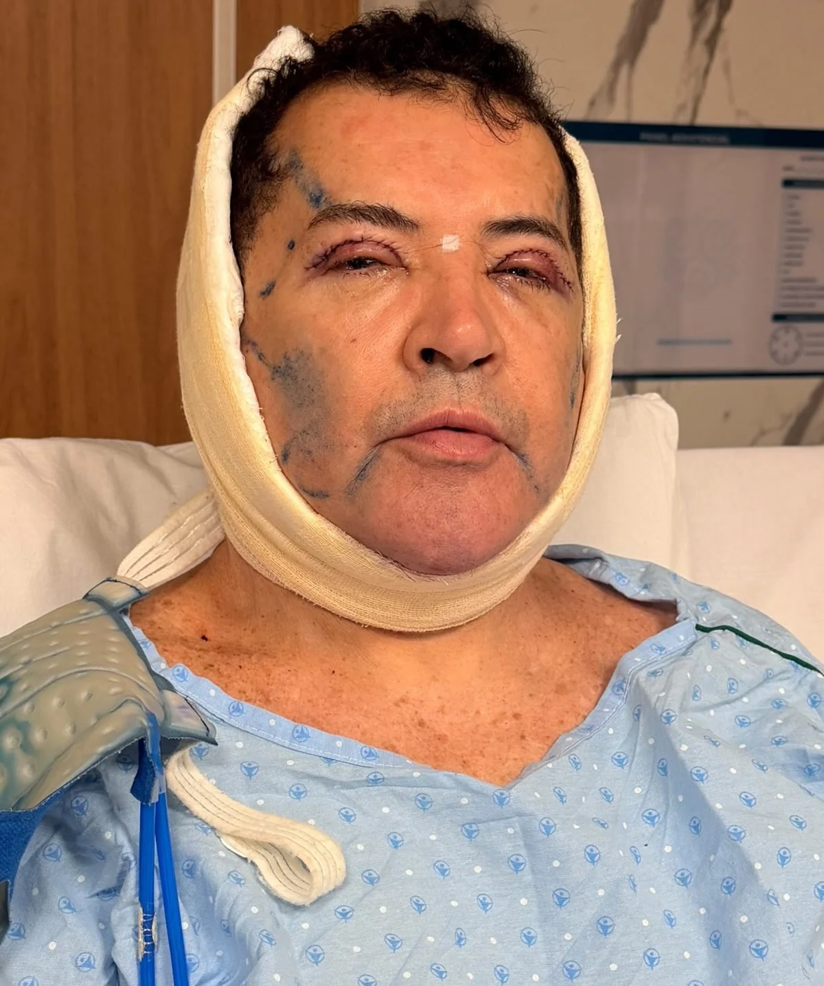 Beto Barbosa choca ao mostrar rosto inchado após plástica: "Novo visual" Beto Barbosa choca ao mostrar rosto inchado após plástica: "Novo visual"