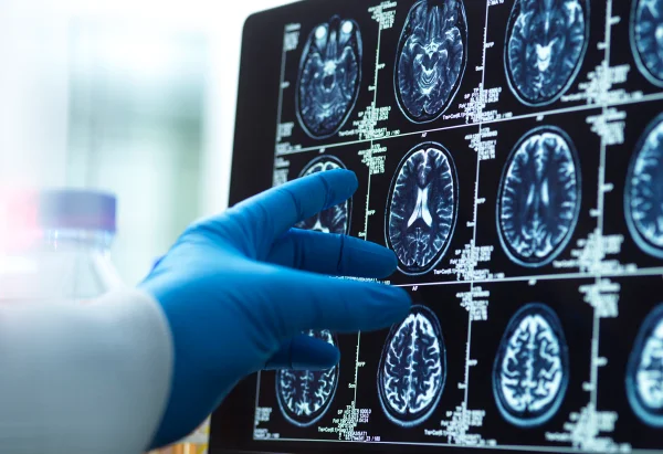 Foto de mão de médico segurando exame de imagem do cérebro - Alzheimer: médica geriatra explica os principais sintomas da doençar - Metrópoles