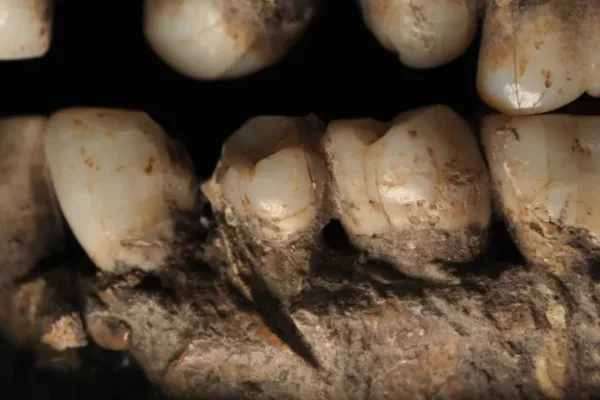 Imagem colorida mostra mandíbula de Homo sapiens ferida - Metrópoles