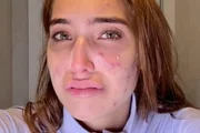 Vanessa Lopes mostra rosto com acnes e desabafa sobre saúde mental