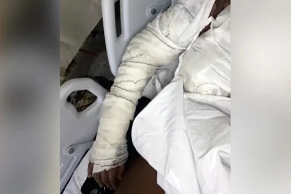 A vítima, sofreu um corte profundo no rosto e queimaduras de segundo grau - Metrópoles