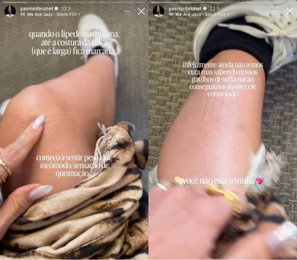 Yasmin Brunet exibe marcas do lipedema e relata dor e queimação - destaque galeria