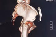 Ele ficou nove meses com a peça metálica em seu corpo