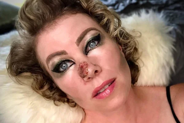 Mulher com maquiagem ao redor dos olhos, deitada, com tumor no nariz - Metrópoles