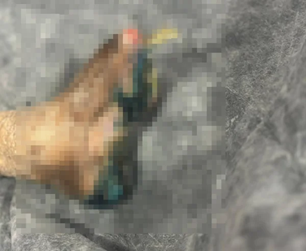 Pé necrosado