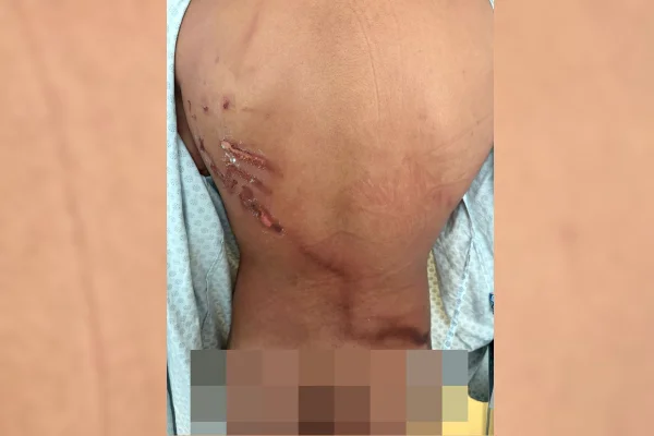 Costas com um grande ferimento causado por raio - Metrópoles