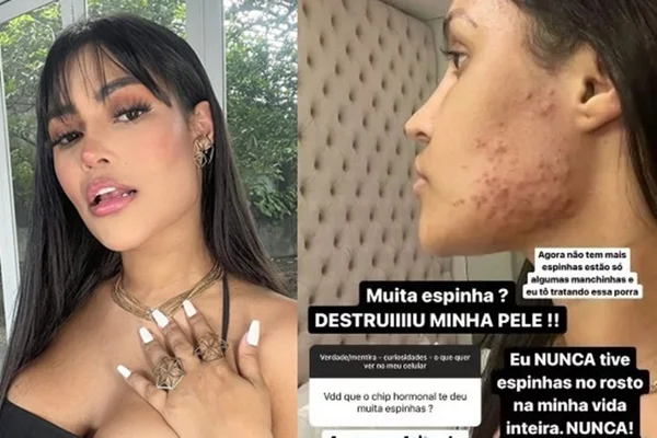 Ex-BBB Flay desabafa sobre “chip da beleza”: “Destruiu a minha pele”