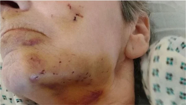 Idosa é atacada por ratazana durante o sono e sofre ferimentos graves