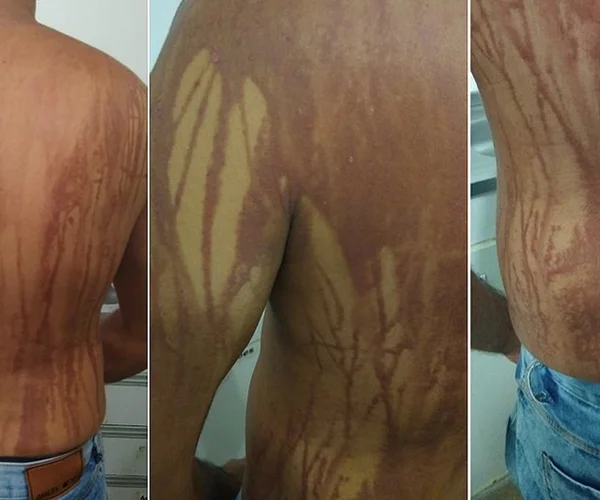 Turista suspeito de intoxicação por óleo em praia tem piora
