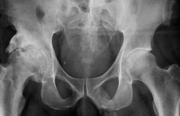 Homem descobre que seu pênis está virando osso e abandona hospital