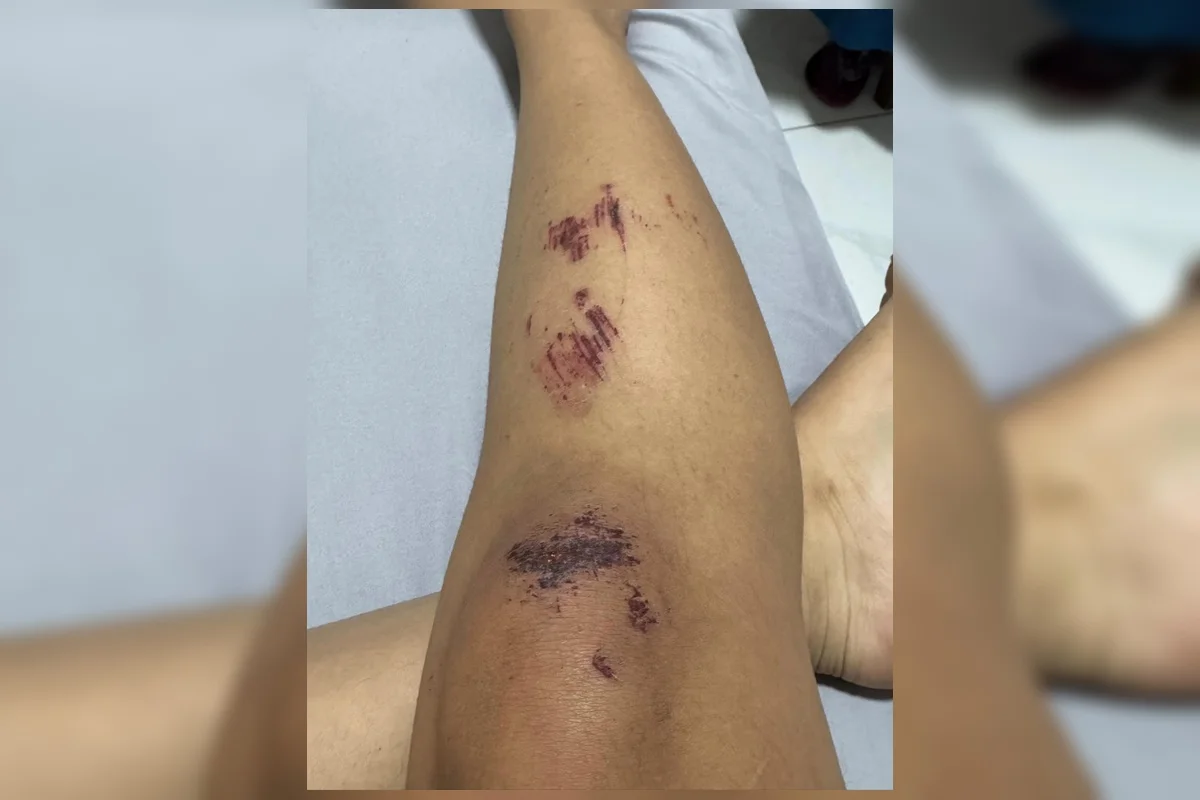 Uma das vítimas compartilhou com o Metrópoles imagens das marcas deixadas pela violência praticada pelo agressor Uma das vítimas compartilhou com o Metrópoles imagens das marcas deixadas pela violência praticada pelo agressor