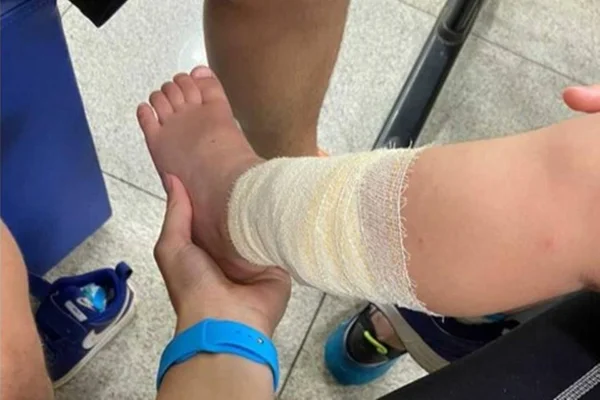 criança de 3 anos mordida por macaco no parque areião de goiânia