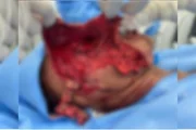 Catador mutilado por pit-bulls passa por reconstrução de face no Rio - imagem 4 Catador mutilado por pit-bulls passa por reconstrução de face no Rio - imagem 4