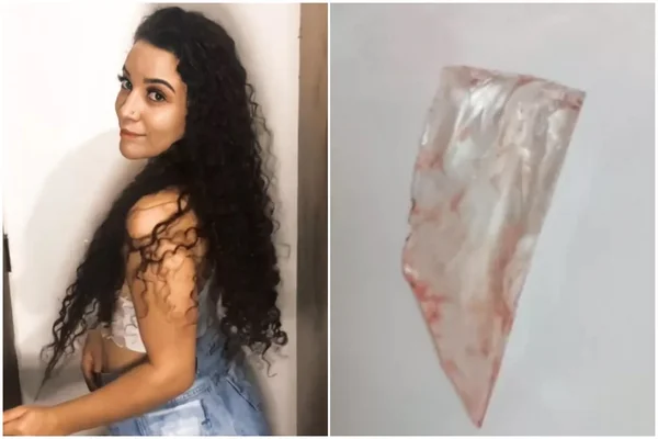Jovem diz que foi atendida em UPA de Praia Grande e médico não viu vidro alojado nas costas