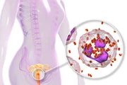 <b>Gonorreia e infecção por Clamídia -</b> Na maioria das vezes, as duas doenças estão associadas. A infecção atinge os órgãos genitais, a garganta e os olhos. Quando não é tratada, a gonorreia pode levar à infertilidade. Os principais sintomas em mulheres são dor ao urinar ou no pé da barriga (baixo ventre), corrimento amarelado ou claro fora do período de menstruação, dor ou sangramento durante a relação sexual. Os homens costumam sentir ardor e esquentamento ao urinar, corrimento ou pus e dor nos testículos <b>Gonorreia e infecção por Clamídia -</b> Na maioria das vezes, as duas doenças estão associadas. A infecção atinge os órgãos genitais, a garganta e os olhos. Quando não é tratada, a gonorreia pode levar à infertilidade. Os principais sintomas em mulheres são dor ao urinar ou no pé da barriga (baixo ventre), corrimento amarelado ou claro fora do período de menstruação, dor ou sangramento durante a relação sexual. Os homens costumam sentir ardor e esquentamento ao urinar, corrimento ou pus e dor nos testículos