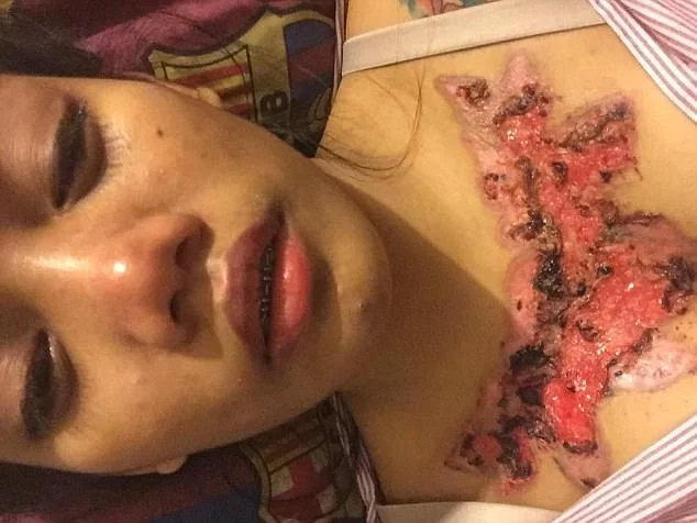 Garota relata momentos de dor ao remover tatuagem com método polêmico - imagem 5 Garota relata momentos de dor ao remover tatuagem com método polêmico - imagem 5