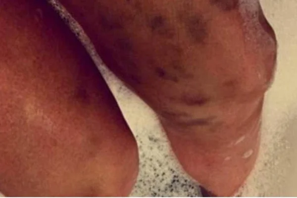 Após discussão com ex-namorado, atriz exibe hematomas na web