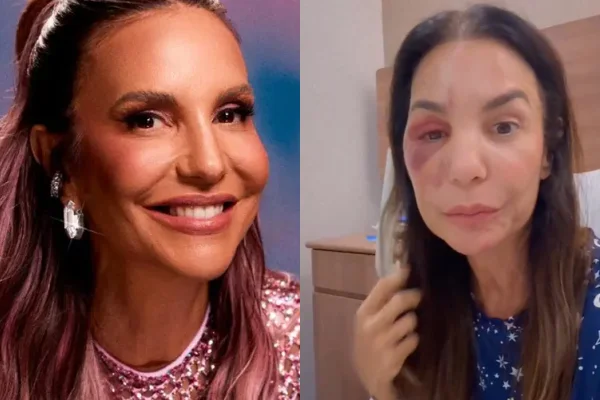 Ivete Sangalo mostra hematoma e esclarece estado de saúde: “Lesão grave”