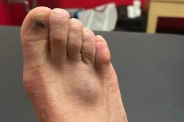 Neymar mostra foto do pé lesionado; e o quadro parece bem grave