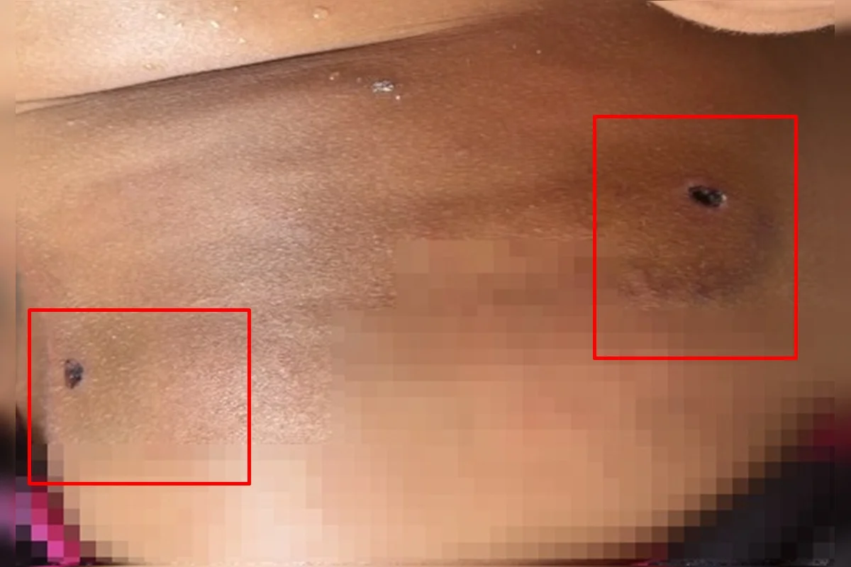 Ferimento provocada pelo disparo Ferimento provocada pelo disparo