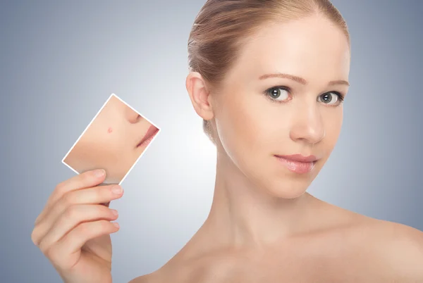Saiba mais sobre o Roacutan, medicamento que vai além do combate à acne