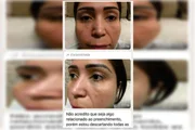 A paciente envia fotos do rosto para descartar a possibilidade de ter sido uma complicação A paciente envia fotos do rosto para descartar a possibilidade de ter sido uma complicação