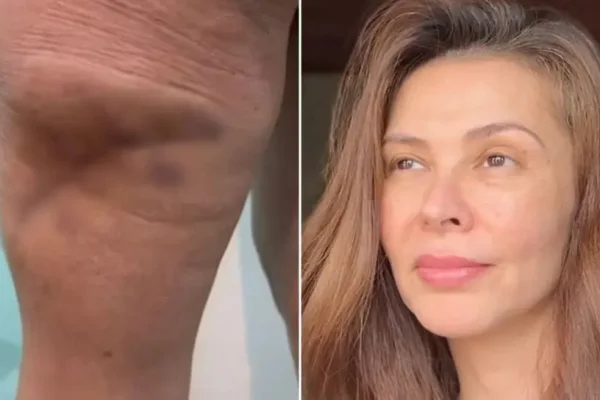 Foto colorida de mulher que passou por procedimento estético e denuncia clínica por necrose