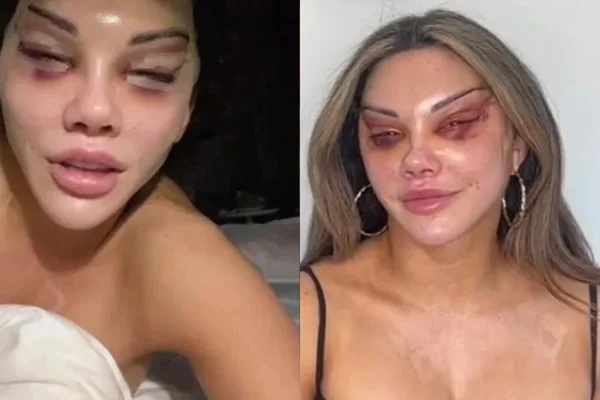 Mulher fica deformada após realizar cirurgia para ter “olhos de gata”